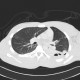 Lung contusion, hemothorax, pneumothorax, chest tube: CT - Computed tomography